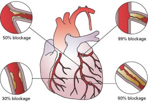 Coronary Heart Disease