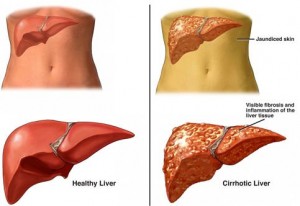 Hepatitis C