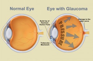 Understanding glaucoma