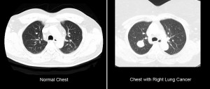 lung cancer screening