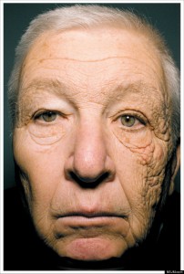 Bill McElligott, a delivery truck driver, has significant UV damage on the side of his face that was always nearest the window of his truck.