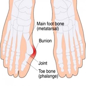 Bunion Surgery