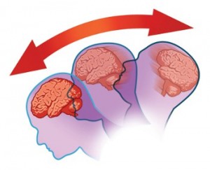 NFL Concussions